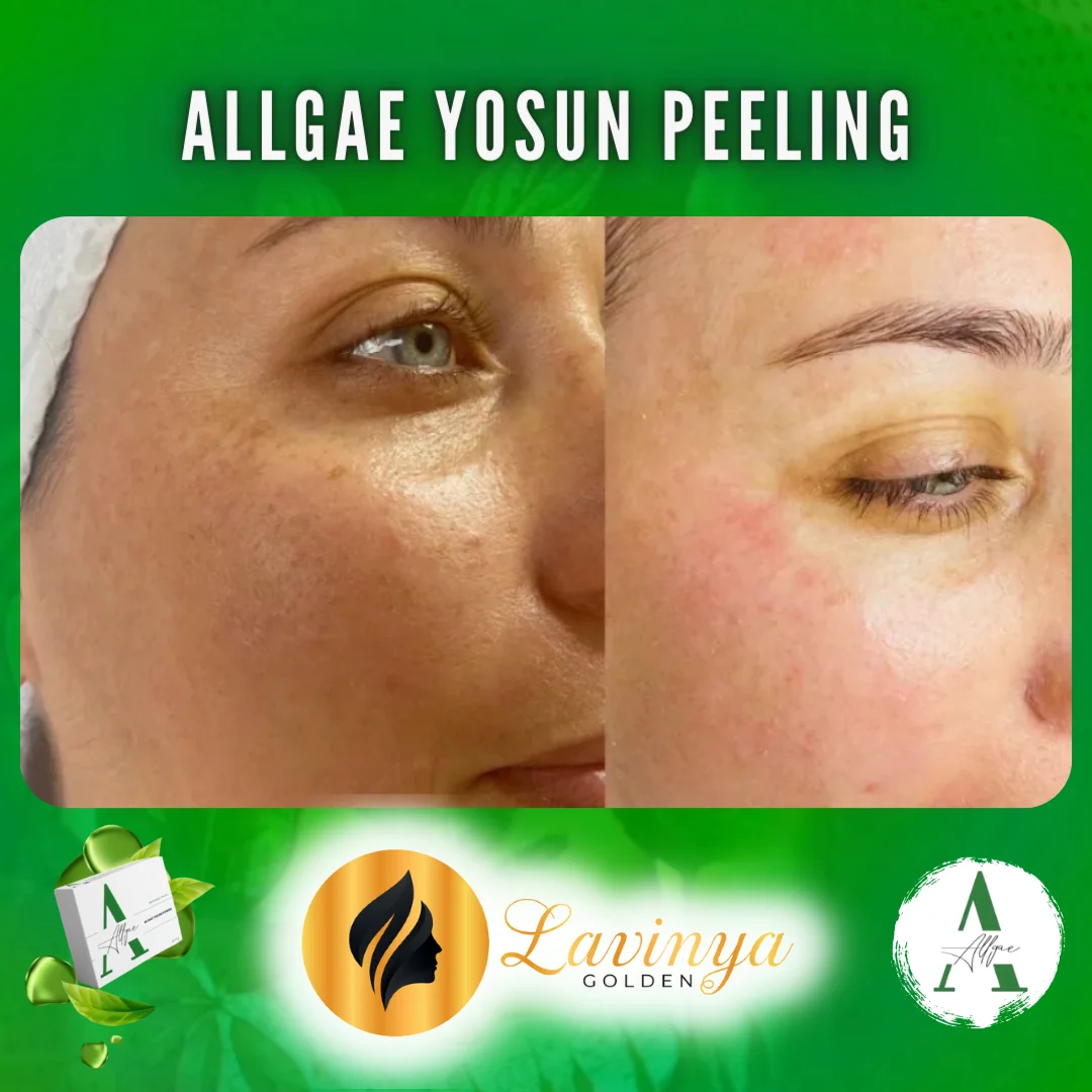 Yosun Peeling