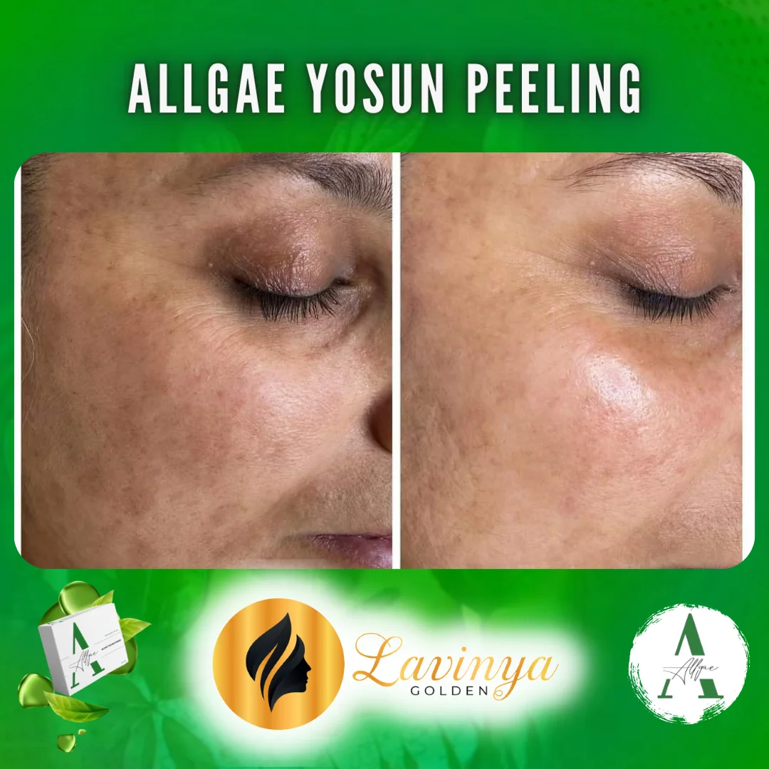 Yosun Peeling