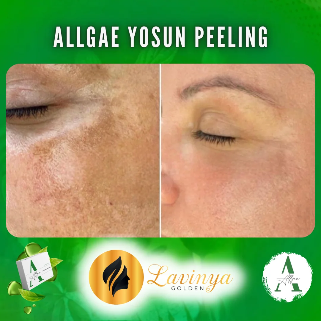 Yosun Peeling